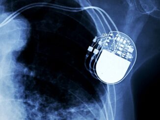 varese sanità pacemaker