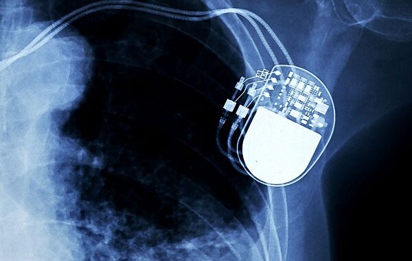 varese sanità pacemaker