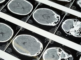 Varese Alzheimer incontro prevenzione