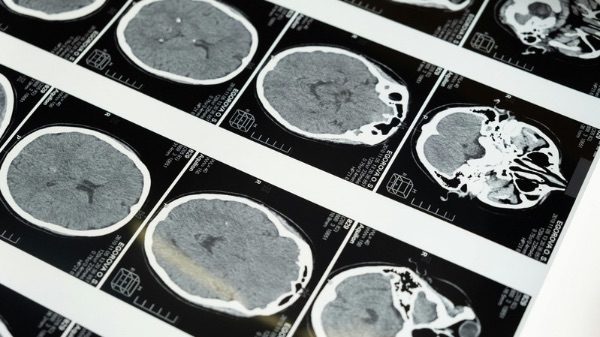 Varese Alzheimer incontro prevenzione